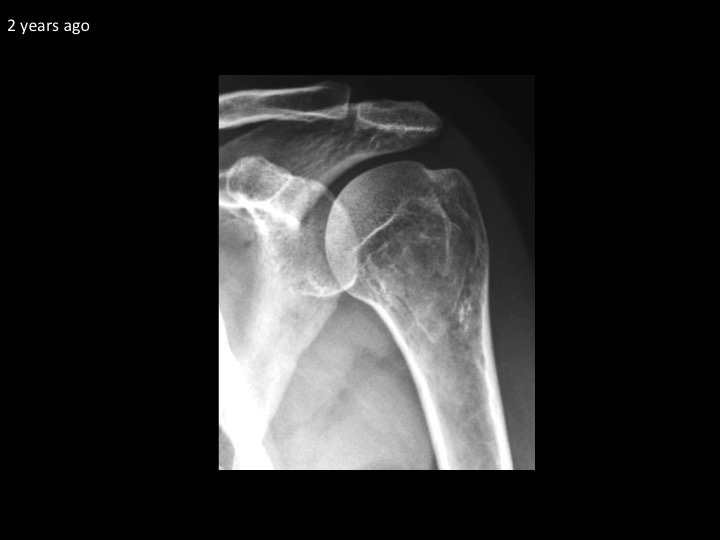 Figure 2 for case simple bone cyst ( RID3945 )